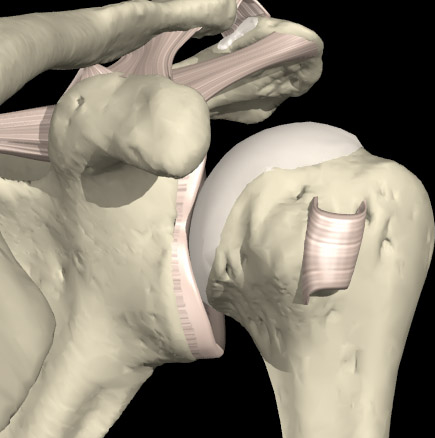 Shoulder operations - Knee, Hip and Shoulder