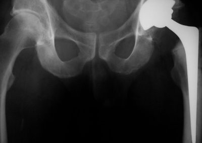 Cemented Hip with normal opposite hip