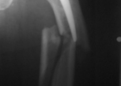 Fractured HIP replacement