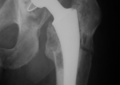 Loose cup with femur fracture