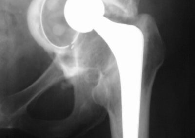Loose cup with pelvic protrusion