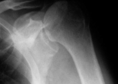 OA SHOULDER WITH CUFF DAMAGE