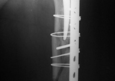 Repaired fracture of HIP replacement