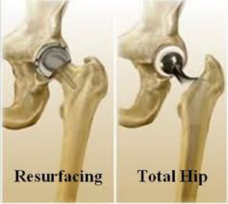 Total Hip Replacement Vs Hip Resurfacing At Layla Swallow Blog