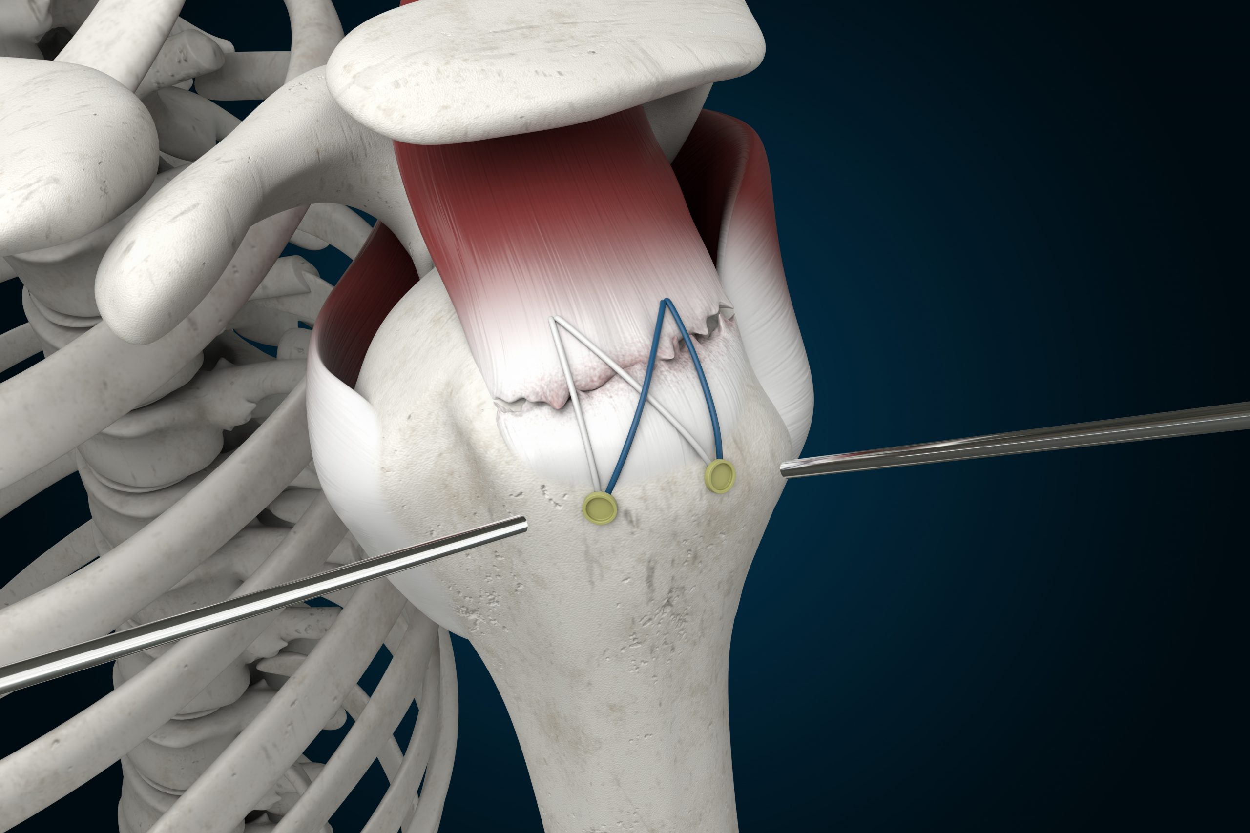 Arthroscopic Rotator Cuff Repair Mini Open Repair Biceps Tenodesis 