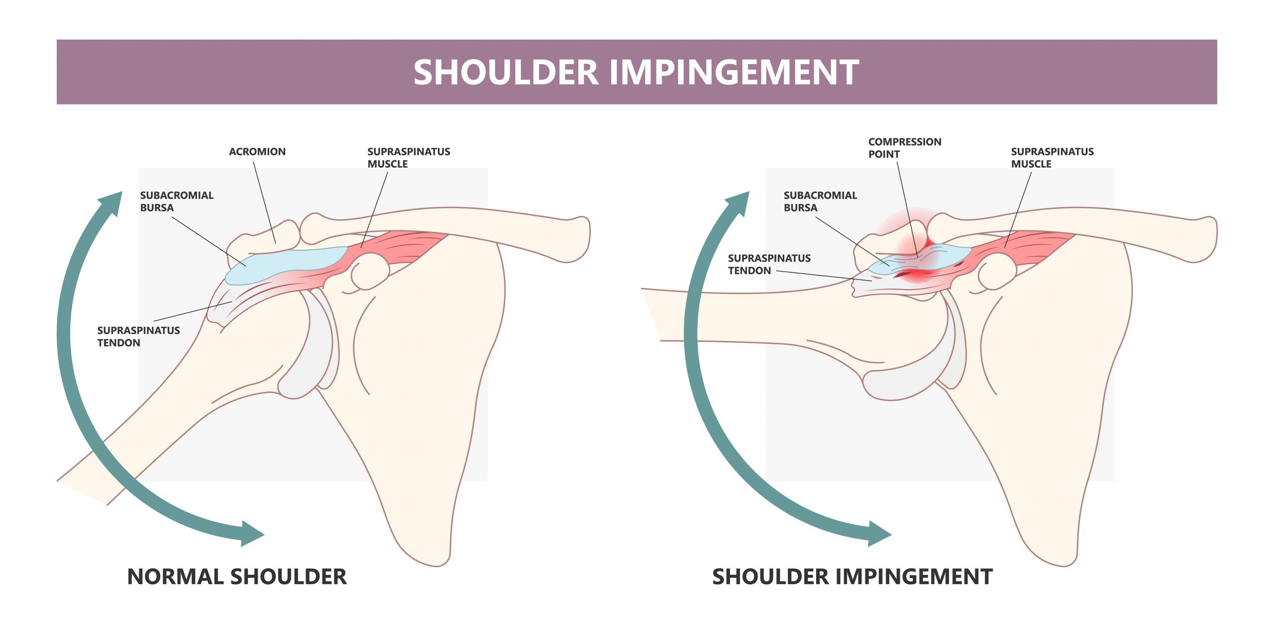 Shoulder Impingement Syndrome Symptoms Causes Diagnosis Shoulder Shoulder Impingement Syndrome Symptoms Causes Diagnosis Shoulder